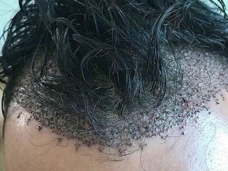 precios del trasplante de cabello